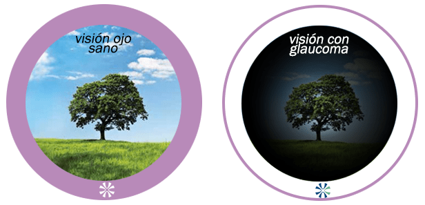 Como ve una persona con glaucoma