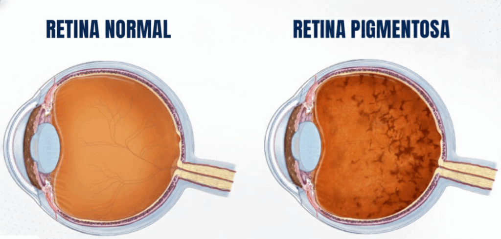 Retinosis Pigmentaria