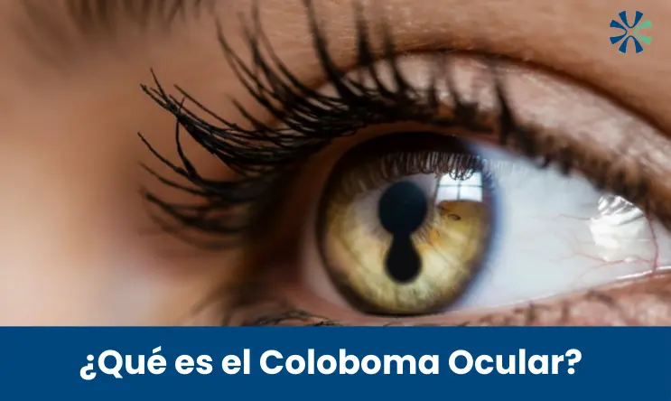 Coloboma Ocular
